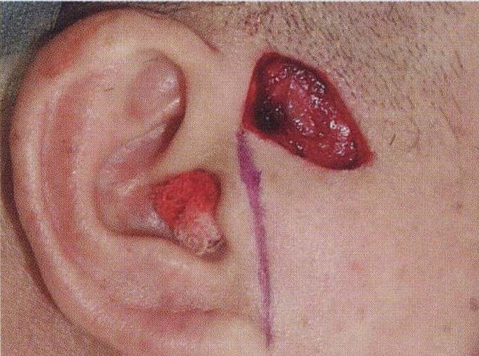 典型病例2:burow楔形皮瓣修复右耳前皮脂腺囊肿切除后创面